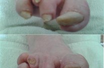 Dystrofia paznokci i deformacja palców